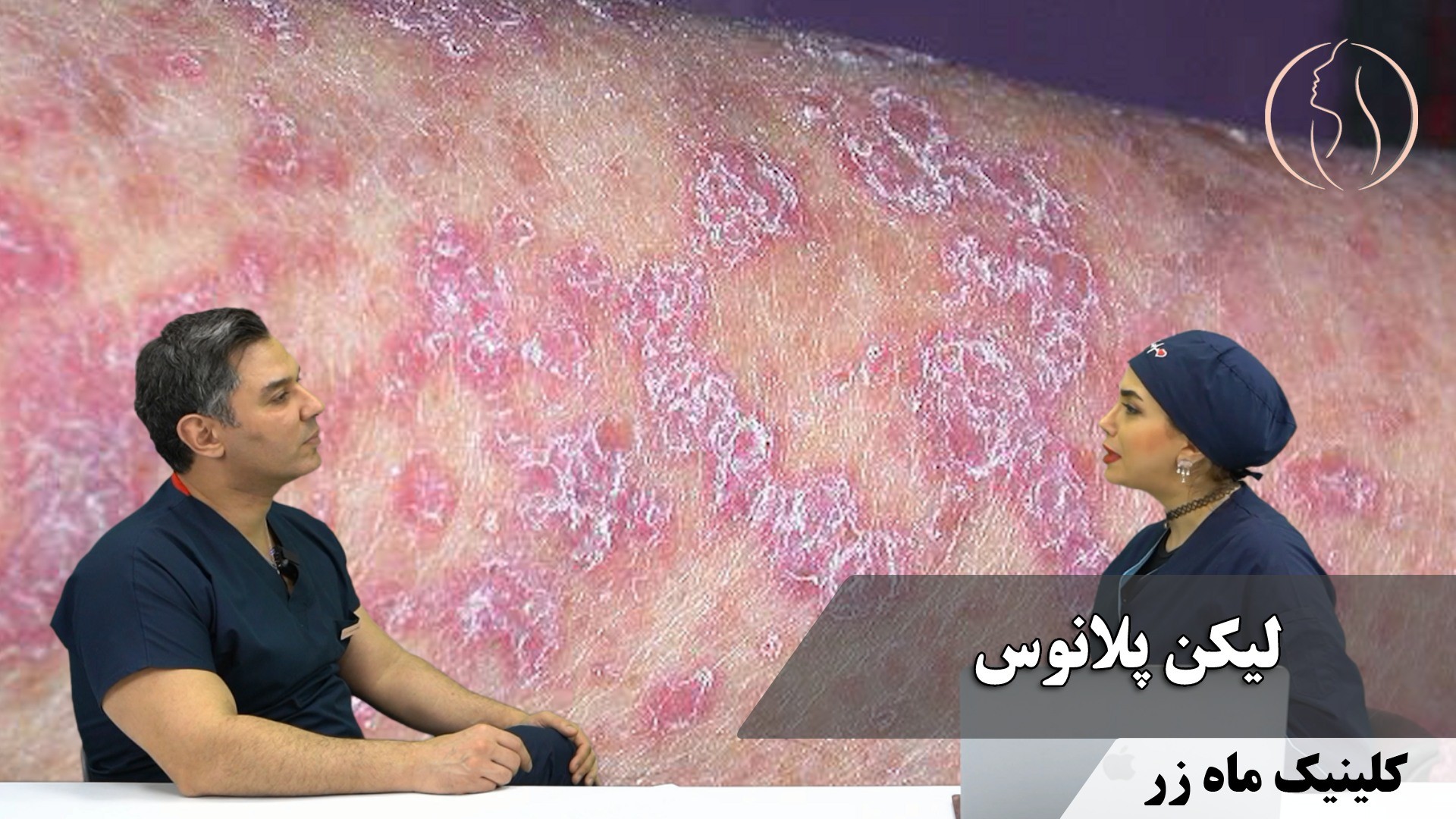 لیکن پلانوس ( هفته نامه شماره ۲۷ کلینیک پوست، مو، و لیزر ماه زر )