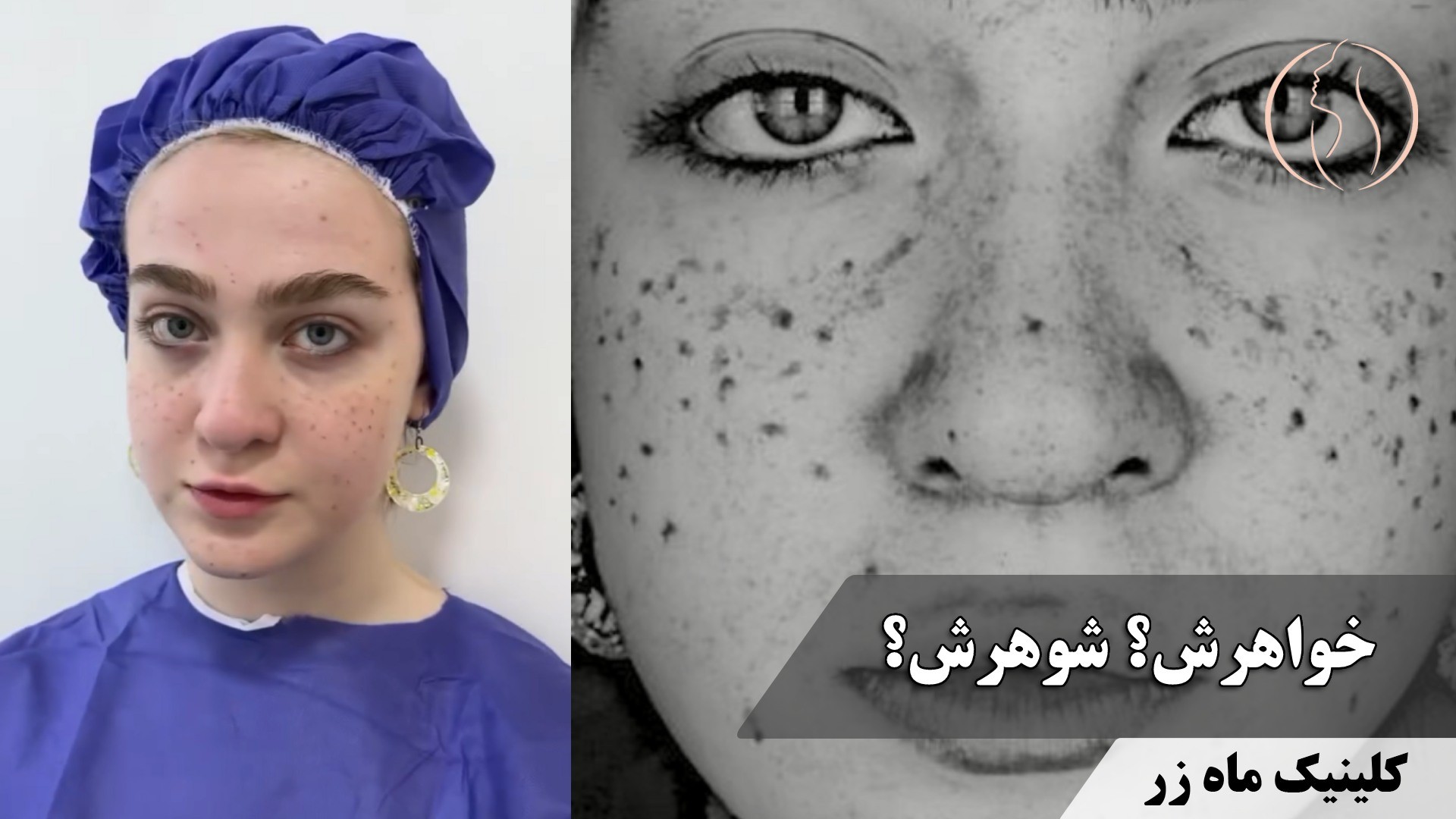 جای جوش و اسکار، دیگر یک مشکل همیشگی نیست! ✨ ( کلینیک ماه زر )