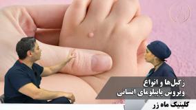 زگیل‌ها ( هفته‌نامه شماره ۲۸ کلینیک پوست، مو، و لیزر ماه زر )