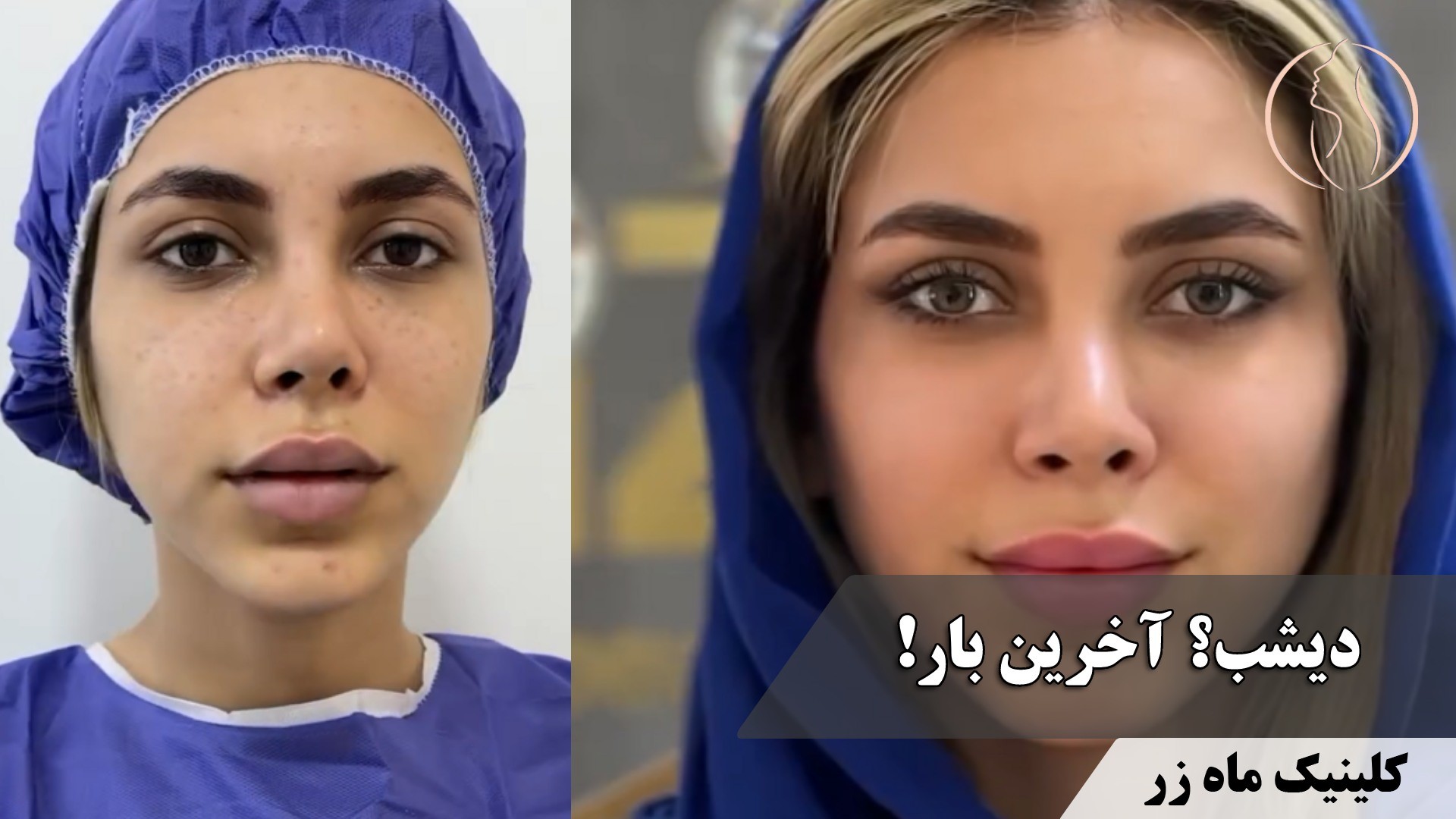 جای جوش‌ها قراره تا کی جلوتو بگیرن؟ ( کلینیک ماه زر )