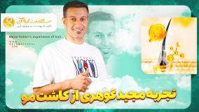 نتیجه کاشت مو بعد از یک سال در کلینیک سلامت ایده‌آل
