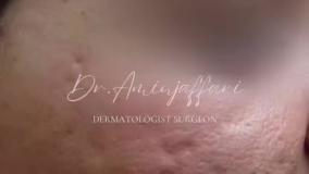 لیزر جای جوش