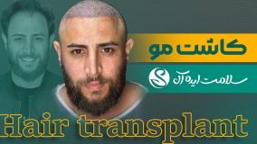 بهترین مرکز کاشت مو در مشهد برای آقایان