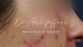 لیزر ترکیبی