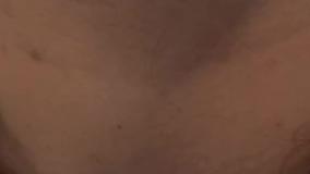 درمان نکروز ناحیه غبغب ساکشن شده