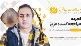 قبل و بعد از کاشت مو در کلینیک سلامت ایده آل