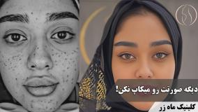 تو آینه خودتو نگاه می‌کنی یا جای جوشاتو؟ ( کلینیک زیبایی ماه زر )