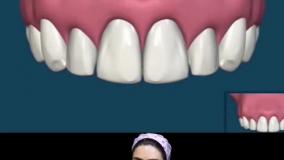 تفاوت های اصلی ایمپلنت و بریج دندان