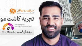 نتیجه کاشت مو بعد از 9 ماه در سلامت ایده آل