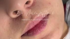 تزریق ژل به لب