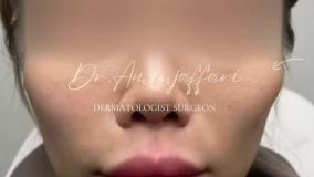 تخلیه ژل سیلیکونی گونه