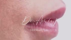 تخلیه ژل پشت لب