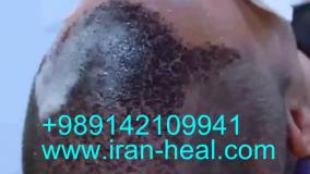 شلون نغسل الشعر المزروع؟ نصايح العناية بعد زراعة الشعر
