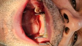 کاشت دندان آقای مهماندوست در مطب دکتر حمید پورصادقی