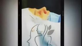 تجميل الأنف في إيران: جمال ودقة بأسعار تناسب الجميع