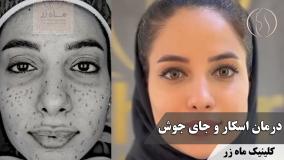 ✨ پوستی بدون جای جوش = آزادی از آرایش ✨ ( کلینیک زیبایی ماه زر )