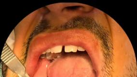 کاشت دندان آقای رضایی در کلینیک دکتر حمید پورصادقی