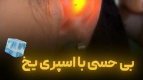 بی حسی با اسپری یخ 🧊