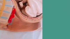 دوختن دهانه رحم برای پیشگیری از سقط