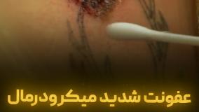 عفونت شدید میکرودرمال