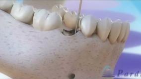 می‌خوای همون روزی که دندونت رو می‌کشی، جای خالیش پر بشه؟