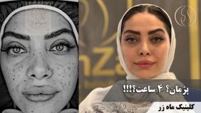 می‌شه جای جوش کمتر شه؟ ( کلینیک زیبایی ماه زر )