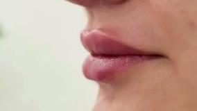 تزریق ژل لب طبیعی