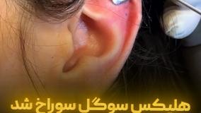 هلیکس سوگل سوراخ شد