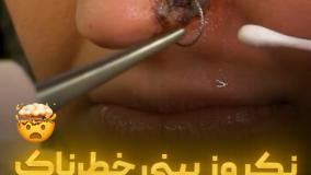 نکروز بینی خطرناک 🤯