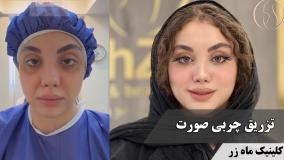 ✨ راز جدید در تقارن و زیبایی چهره ✨ ( کلینیک زیبایی ماه زر )