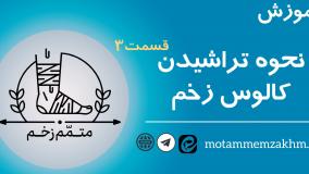 آموزش نحوه تراشیدن کالوس  (متمم_زخم) 3