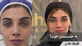 ✨ خداحافظی با جای اسکار ( کلینیک زیبایی ماه زر )