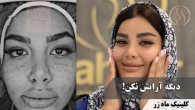 تأثیر جای جوش و اسکار روی زندگی دختران + راه‌حل تک‌جلسه‌ای ✨ ( کلینیک ماه زر )