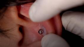 درمان کلوئید