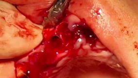 دکتر متخصص کاشت دندان دائمی در تهران-مطب دکتر حمید پورصادقی