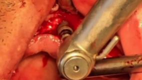 دندانپزشکی با بیهوشی عمومی در تهران توسط دکتر حمید پورصادقی