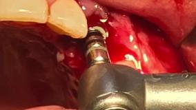 فیلم کاشت دندان (ایمپلنت دندان) کلینیک دکتر حمید پورصادقی