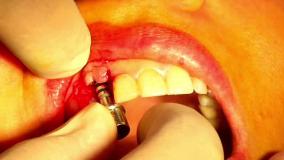 ایمپلت دندان قسطی در تهران در مطب دکتر حمید پورصادقی