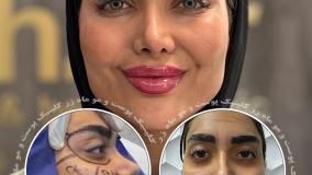 تزریق چربی متد بایوفت ( کلینیک ماه زر - دکتر میثم ضرغامی )