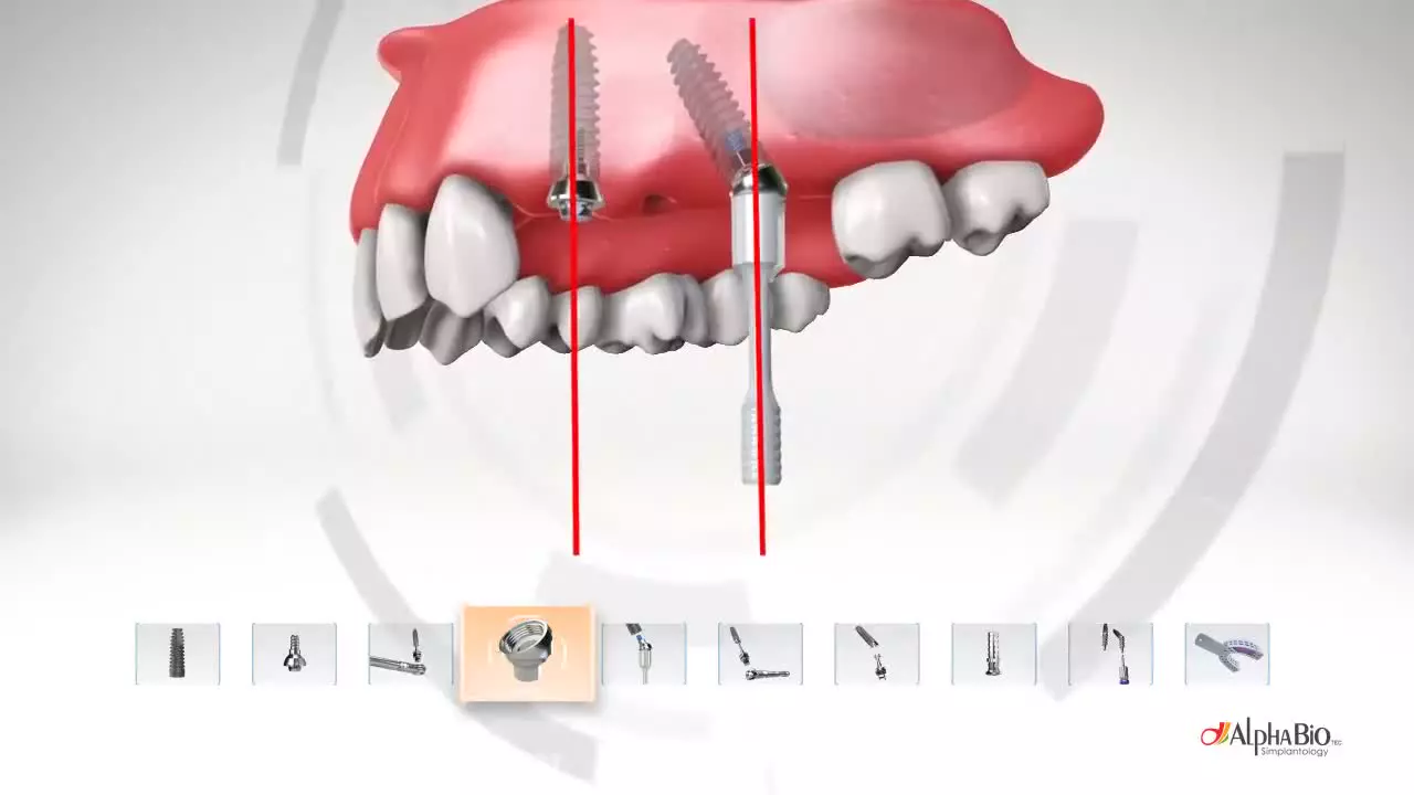 آشنایی با ایمپلنت دندان