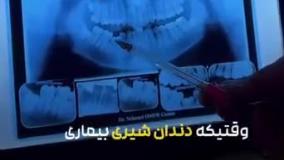 این دندون حتما باید ایمپلنت بشه! _ کلینیک نوتاش
