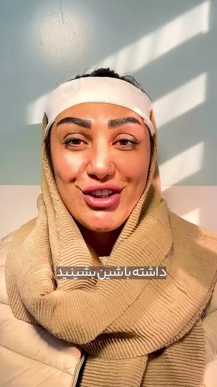 کاشت ابرو برای خانومی که دیابت داشت در کلینیک آفرینش