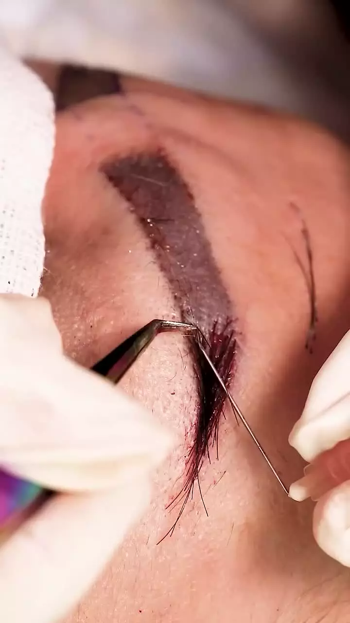 کاشت فولیکول ابروها از زاویه نزدیک در کلینیک آفرینش