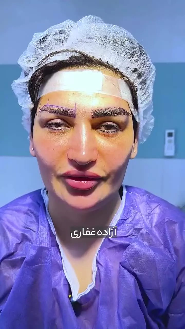 ویدیو رضایت از کاشت ابرو در کلینیک آفرینش