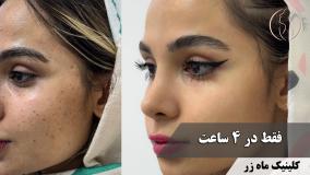 کم‌رنگ کردن ردِ سال‌ها آکنه و جای جوش ( کلینیک ماه زر - دکتر میثم ضرغامی )