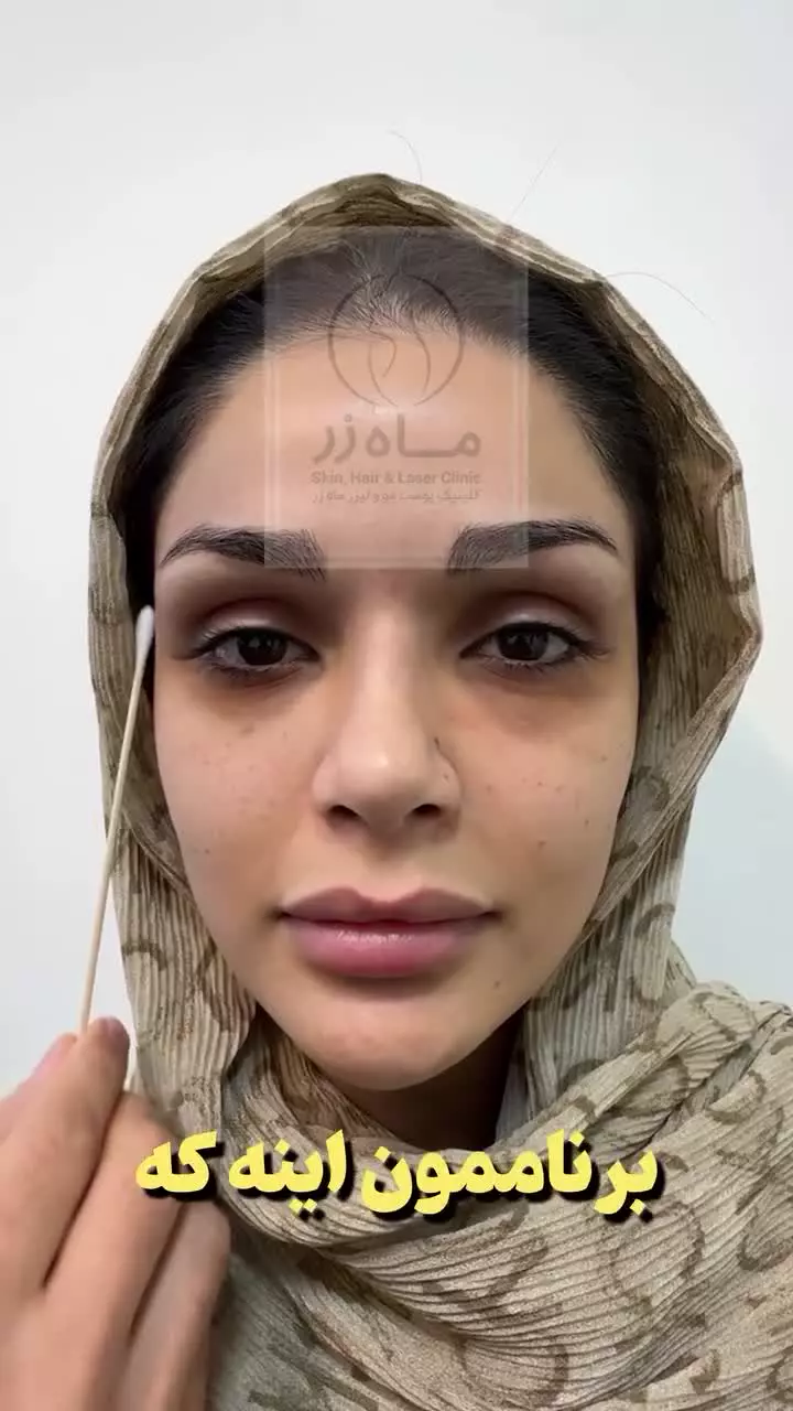 تزریق چربی به روش بایوفت ( کلینیک ماه زر - دکتر میثم ضرغامی )